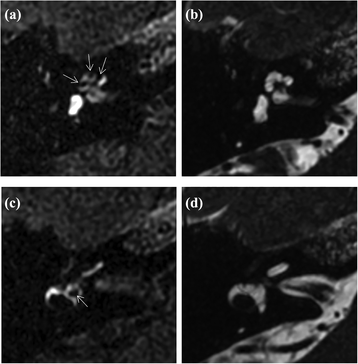 Four magnetic resonance images labeled a through d show cross-sectional views of the temporal bone and inner ear. Arrows in panels a and c mark small bright structures beside the cochlear and vestibular region. Panels b and d show corresponding rounded and tubular inner-ear structures within the surrounding anatomy.