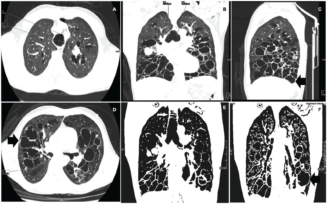 Six computed tomography images of the chest labeled A through F show both lungs in axial, coronal, and sagittal views. The lungs, central airways, heart and mediastinum, ribs, chest wall, and diaphragm are visible. Multiple rounded dark air spaces occur throughout both lungs. Measurement lines and arrows mark selected regions.