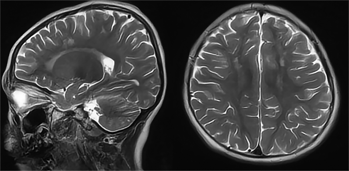 This image depicts an axial and sagittal T2-weighted magnetic resonance image of a patient’s brain. Both hemispheres of the brain are visible as are the structures of the face and skull.
