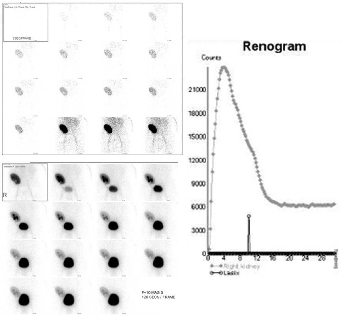 Renal nuclear medicine study combines serial planar images and a renogram. Early frames at 3 seconds per frame show tracer signal in the right kidney. Later frames at 120 seconds per frame show signal in the kidney and urinary bladder. The renogram plots counts over time for the right kidney and bladder, with the kidney curve peaking early and then declining to a plateau. The tracer is not identified.