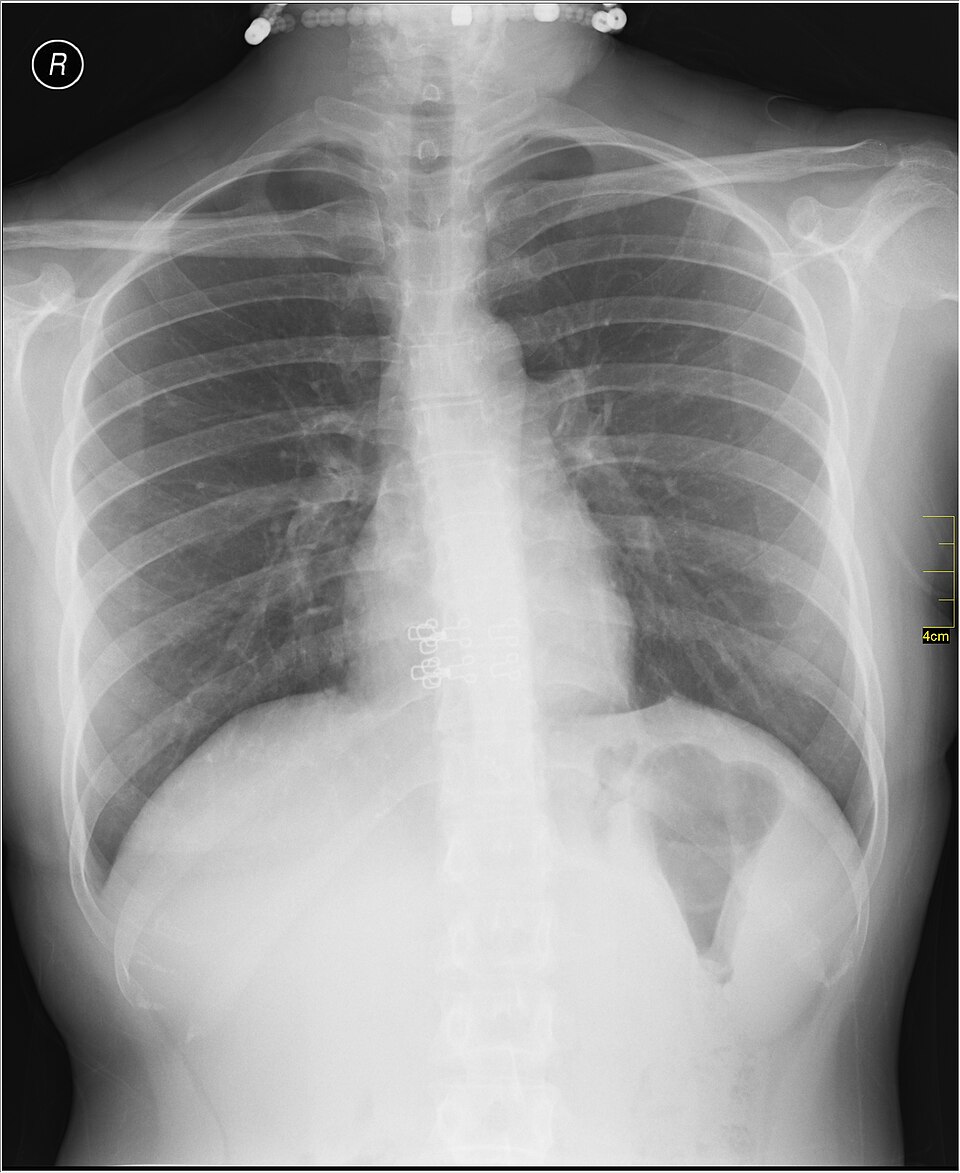 This image depicts an anterior radiograph of the chest cavity. The ribs and clavicle are visible and the heart silhouette appears on the right side of the image.