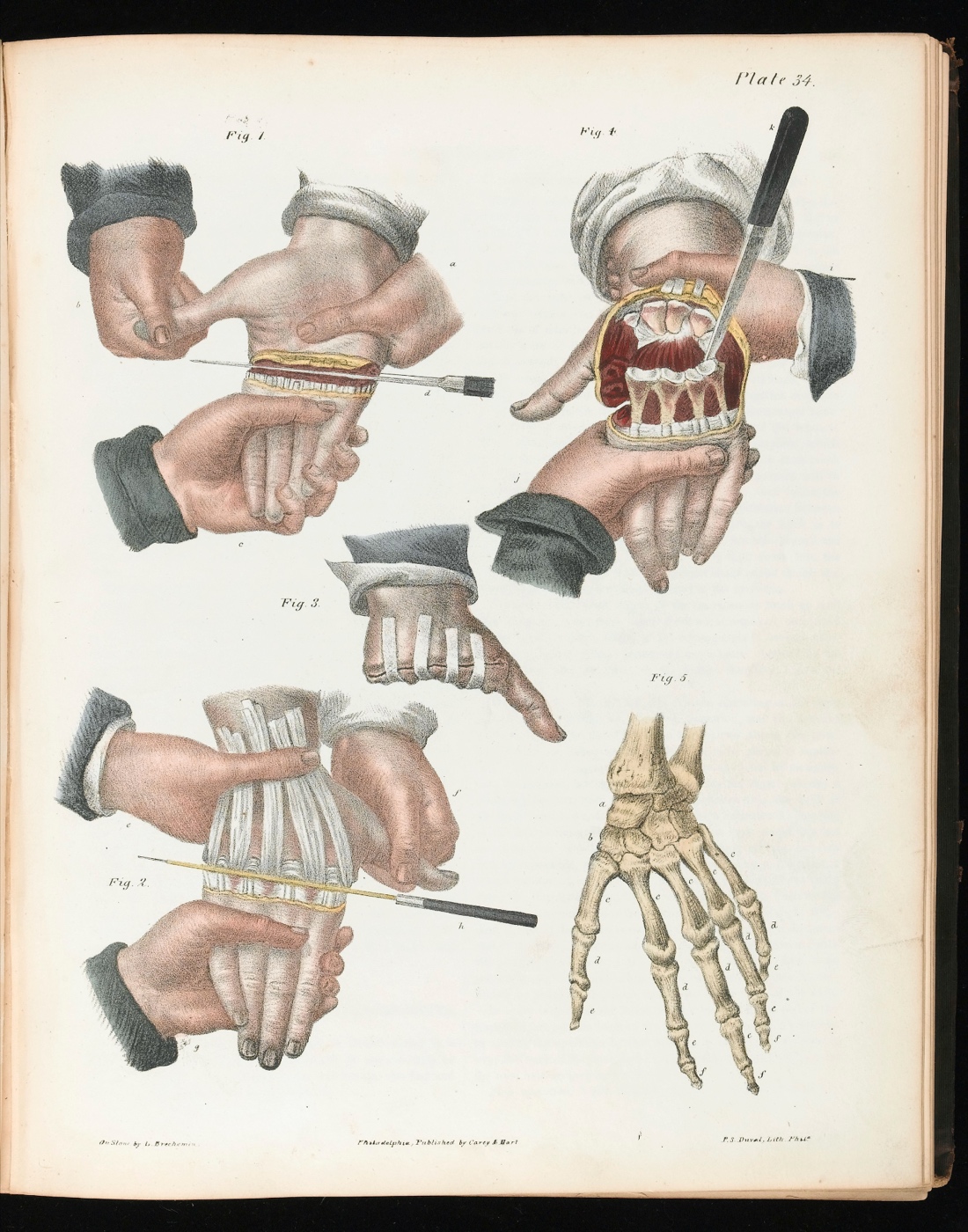 An illustration with five figures depicting the amputation of four fingers at the metacarpophalangeal joints. Figure one depicts a scalpel cutting into the joint at the palm. Figure two depicts the same scalpel cutting into the joint from the backside of the hand. Figure three depicts the hand post-amputation with sutures and medical tape. Figure four depicts the amputation of the fingers with an interior view of the musculature view of the hand. Figure five depicts a labeled diagram of all of the bones in the hand.