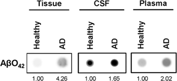 Dot blot comparing AβO₄₂ levels in tissue, CSF, and plasma. Each sample includes a healthy and AD dot, with quantified values of 1.00 vs. 4.26 in tissue, 1.00 vs. 1.65 in CSF, and 1.00 vs. 2.02 in plasma. AD dots show visibly stronger intensity overall.