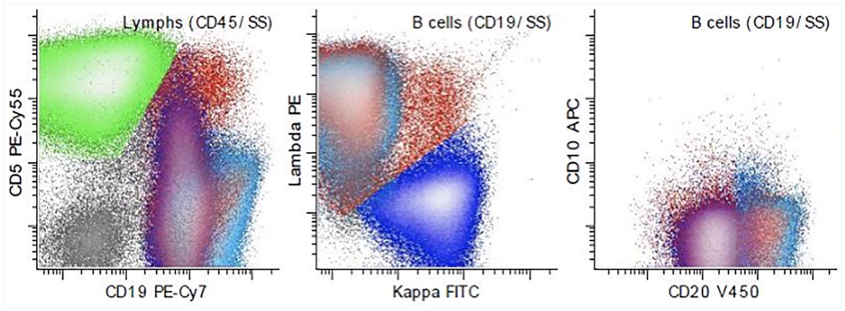 Three flow cytometry dot plots compare marker signals. The first plots CD5 PE-Cy55 against CD19 PE-Cy7, with dense clusters in the upper left and lower right. The second plots Lambda PE against Kappa FITC, with an upper-left cluster and a dense lower-right cluster. The third plots CD10 APC against CD20 V450, with two dense lower clusters and sparse points above.