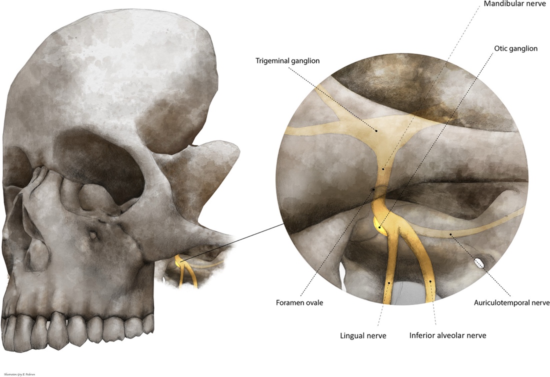 Anatomical illustration shows a lateral skull with an enlarged view of the infratemporal region. The mandibular nerve extends from the trigeminal ganglion through the foramen ovale and divides into the auriculotemporal, lingual, and inferior alveolar nerves. The otic ganglion lies beside the mandibular nerve near the foramen ovale.